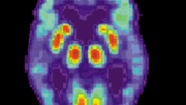 Сероводород может защитить от болезни Альцгеймера